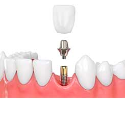 Dental-Implants-Hertfordshire