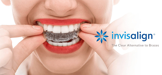 Invisalign-near-me